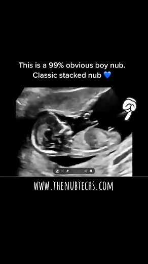 Classic Boy Nub at 12 Weeks | Gender Prediction