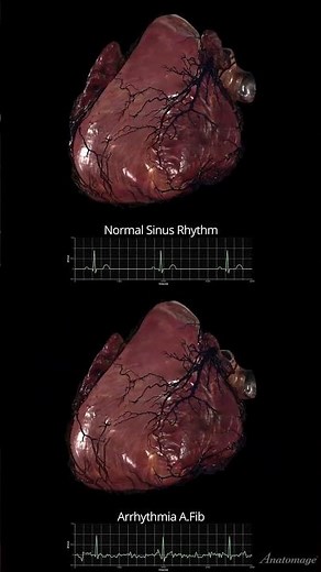 Atrial Fibrillation (AF)