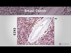 Epigenetics Drivers of Breast Cancer