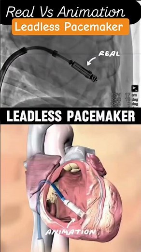 Leadless Pacemaker Animation vs Reality Uncovered | MICRA Pacemaker Explained #shorts