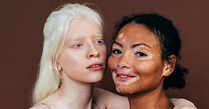 Here's how to take care of albinism skin