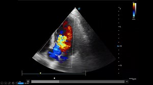 This is the first and most important trick to learn in advanced critical care U/S. Register in our recorded online course to learn so many critical care U/S tricks which will change your way of management and boost your ICU skills. We are continuously upgrading our courses., so you will expect new lectures to be added to your course from time to time. Attention please, now the complete Lower Limb arterial and venous Doppler course is added to our recorded critical care U/S from basic to advanced