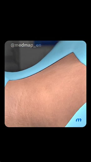 EraScope on Instagram: "Endoscopic spine relief is a modern surgical technique used to treat chronic back and neck pain caused by pinched nerves, herniated discs, or spinal stenosis. Instead of large incisions, doctors use a tiny camera (endoscope) and micro-instruments to reach the problem area through a very small opening, often less than 1 cm. Because the procedure is so precise, it causes minimal damage to muscles and surrounding tissue. This means less bleeding, less pain after surgery, and