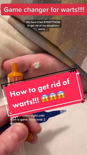 Effective Wart Removal Solution: Wartpeel from Dermatologist