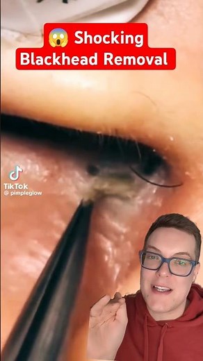 Shocking BLACKHEAD REMOVAL - Blackhead Inside Nose!! #shorts