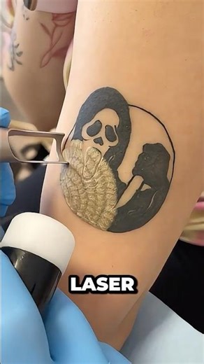 How Tattoos Are Actually Removed