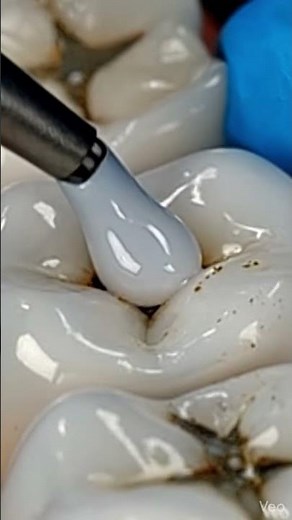 Black Spot on Tooth? It’s Getting Worse! 😨