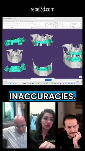Intraoral scanner bites aren’t always accurate.