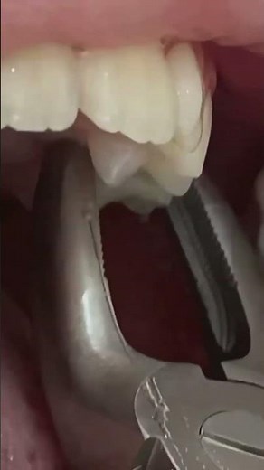 Süt diş çekimi nasıl yapılır // baby tooth extraction.