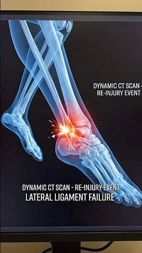 Why Your Ankle Keeps Rolling Again and Again 😱 #anklesprain, #anklepain, #injury, #shorts, #anatomy