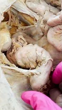 Cancer Spreading to the Liver