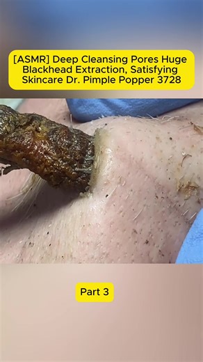 Deep Cleansing Pores: Huge Blackhead Extraction ASMR