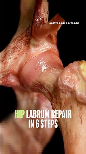 How To Replace Your Hip Cartilage - In 6 Steps!