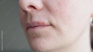 virus herpes simplex on lip skin, sore vesicles cause discomfort of herpes bumps on woman face. smiling woman face with herpes on lip. itching burning feeling symptoms upper lip viral disease herpes