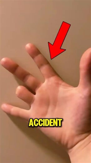 Finger Cut Off Do THIS Immediately to Save It 😱