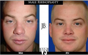 Improving Nasal Tip Definition| Rhinoplasty for Nose Refinement - Dr. Jose Barrera: San Antonio Facial Plastic Surgeon & ENT