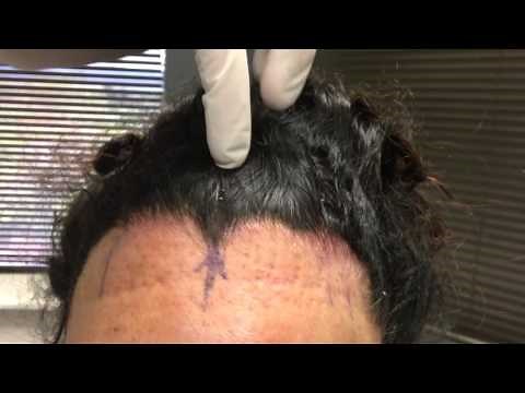 Endoscopic Brow Lift Post Op Care