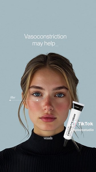Get Rid of Dark Circles Naturally Without Injections
