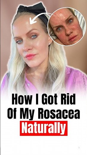 HOW I GOT RID OF MY ROSACEA NATURALLY
