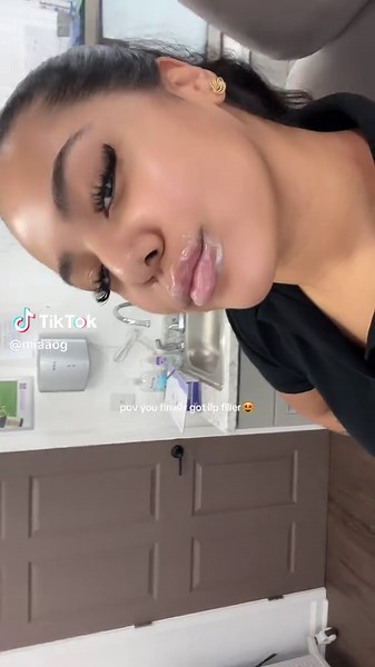 Lip Filler Experience: Journey Through Day 4