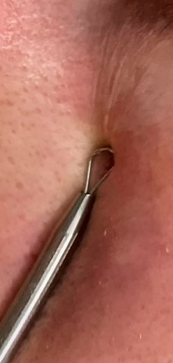 #blackhead #blackheads #blackheadsremove #blackheadremover #blackheadsremoval #blackheadextraction #blackheadlover😍😍 #blackheadcleaning #blackheadcrew #pimplepop