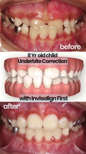 Invisalign Before After for Underbites correction in 8 Yrs old #invisaligntreatment #dentist