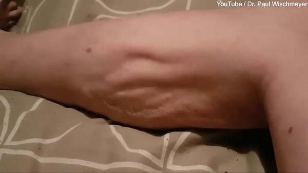 Doctor shares video footage of extreme leg cramp