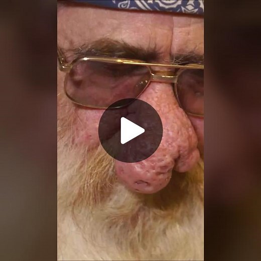 Terry sometimes wakes up gasping for breath because of his large nose cyst. Can Dr. Lee come to his rescue? #DrPimplePopper #TLC