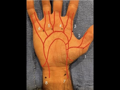 Drs. Ghareeb and Dempsey: Botulinum Injection for Hand Ischemia & Raynaud's