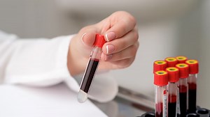 Why And When Should You Get A Hematocrit Test