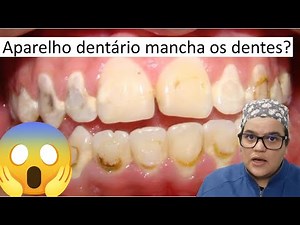 Do braces stain or cause cavities in teeth? | Dr. Bianca Rosa | Bianca Rosa Clinic