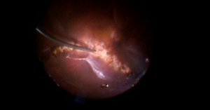 Highly Myopic Retinal Detachment With Crystalline Lens - Eyetube