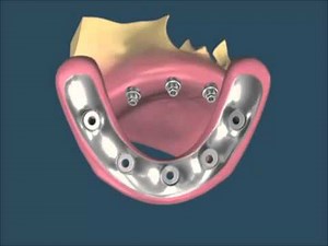 Protesis hibrida sobre Implantes