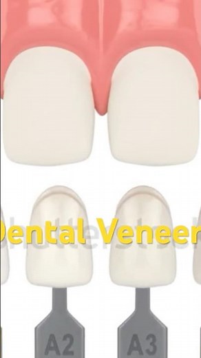 “Dental Veneers Procedure Explained in 30sec!”
