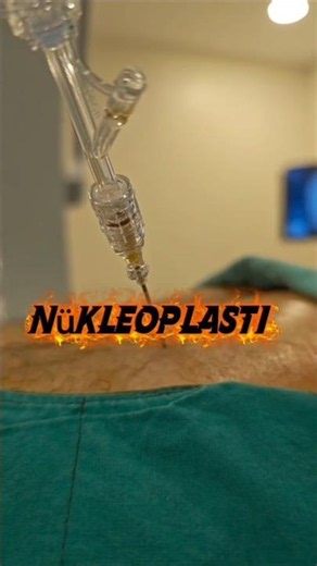 What happens during laser nucleoplasty for a herniated disc? #painmanagement #nucleoplasty #nucle...