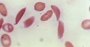 U.S. FDA approves 2 sickle cell gene therapies in medical breakthrough