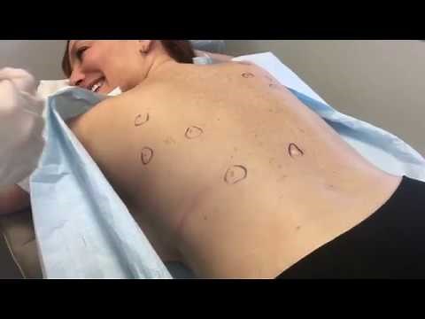 Seborrheic Keratosis: What It Is and How to Get Rid of It