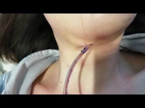 Neck Drain Care in Child | Drain Out Procedure Explained | Select Hospital Nursing Life