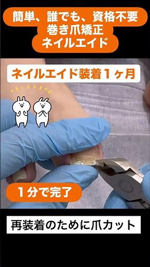 Anyone can easily use the "Nail Aid" ingrown toenail correction device. This video demonstrates h...