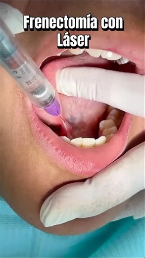 Does your child have a tongue-tie? See how we correct it painlessly.