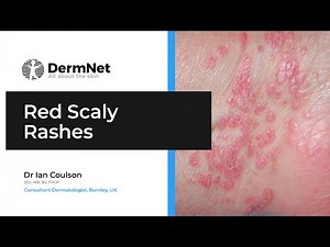 Spotlight on Red Scaly Rashes: Dermatologist's Insights to Lichen Planus, Pityriasis Rosea, and More