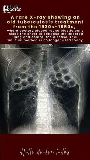 A rare X-ray showing an old tuberculosis treatment from the 1930s–1950s #healthchannel #doctorslife