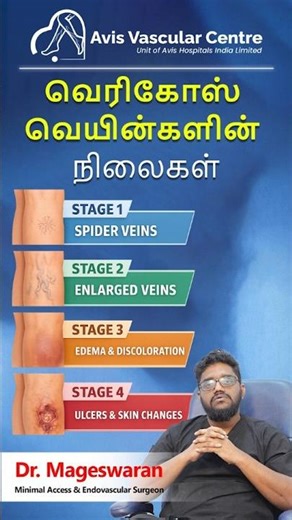 Stages of Varicose Veins & Skin Changes Explained | Dr. Mageswaran | Avis Hospitals