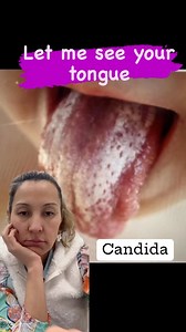 Candida is an infection that is a fungus that causes Candidiasis. Candida overgrowth will present with skin, rashes, bowel issues, mood swings, in ability to lose weight, indigestion, UTI, constipation, gas, bloating, joint pain. How do we get rid of candida? Eat less sugar! Try this supplements: garlic, coconut oil, oregano, oil, curcumin, Alex Vera, pomegranate, kombucha, probiotic. Fungus and mold a neurotoxins that probably have it in your body and exhaust your body on daily basis and make y