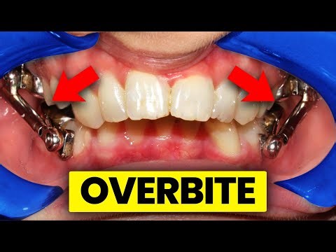 4 ways to correct your OVERBITE…[under 3mins] | Orthodontist Explains