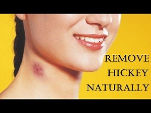 How to Get Rid of Hickies Fast - Remove a Hickey At Home