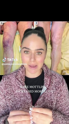 Understanding Hospice Mottling Skin: A Nurse's Guide