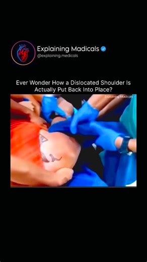 Medical | Health | Anatomy on Instagram: "A shoulder dislocation happens when the upper arm bone pops out of its socket, usually after a fall or sudden force. Fixing it—called a reduction—looks intense, but the process is controlled and highly precise. Doctors don’t “force” the bone back in; instead, they use specific maneuvers that relax the surrounding muscles so the joint can slide naturally back into place. First, the patient is assessed to rule out fractures or nerve damage. Pain relief or 