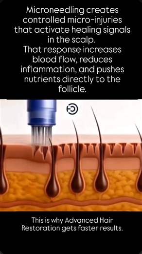 Here’s why microneedling exosomes outperforms everything else. Microneedling boosts blood flow, oxygen, and nutrient delivery. It also opens micro-channels so treatments don’t just sit on top of your scalp. Exosomes send growth instructions to weak follicles and reduce inflammation that blocks regrowth. This combo doesn’t mask hair loss. It changes follicle behavior. Ready to stop guessing? DM me RESTORE to get started. | The Alopecia Doctor Hair and Scalp Spa