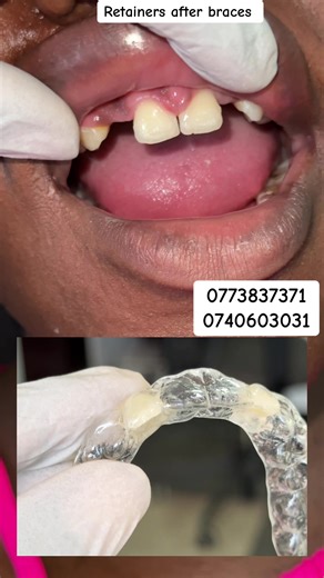 Retainers fixed with a denture after braces #dentures #braces #bracelet #bracesoff #denture